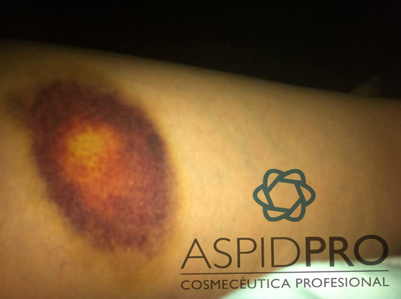 moreton hematoma