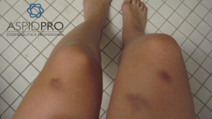 golpe hematoma moreton